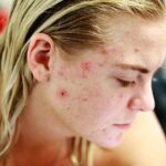 Comment se débarrasser de l'acné rapidement et naturellement ? 615e761298e26.jpeg